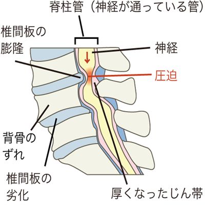 脊柱管狭窄症の画像