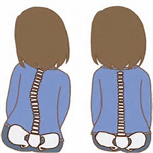 脊柱側弯症の画像