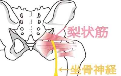 坐骨神経痛詳細画像